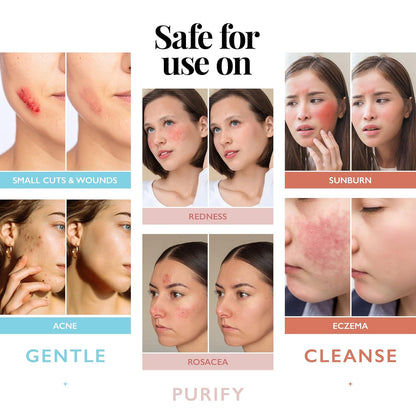 Revitalize Your Skin with Hypochlorous Acid Spray - Antimicrobial Facial Cleanser & Skin Mist for Acne, Eczema, and More - 4oz of Smart Skincare